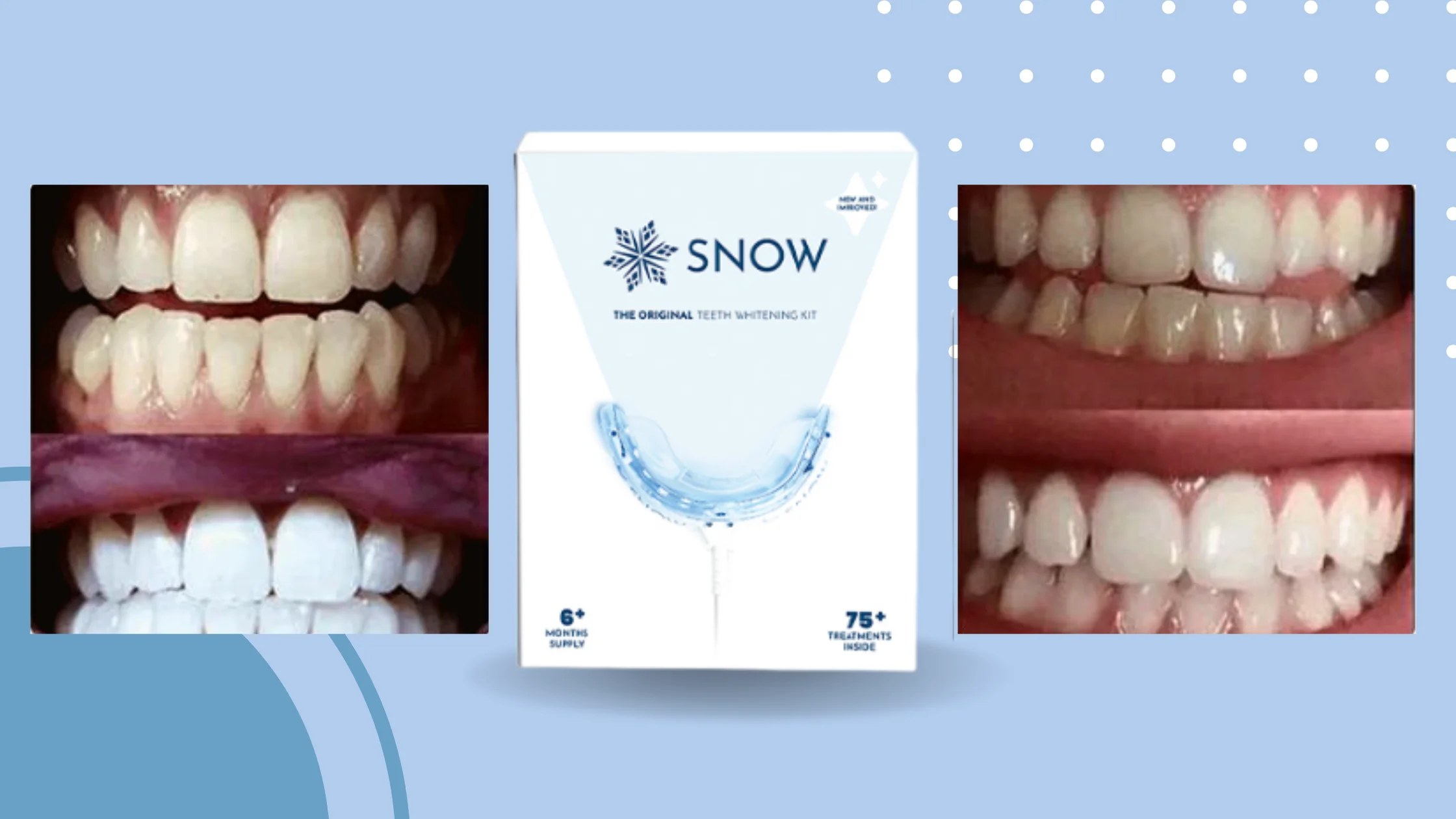 Snow Teeth Whitening Before And After 