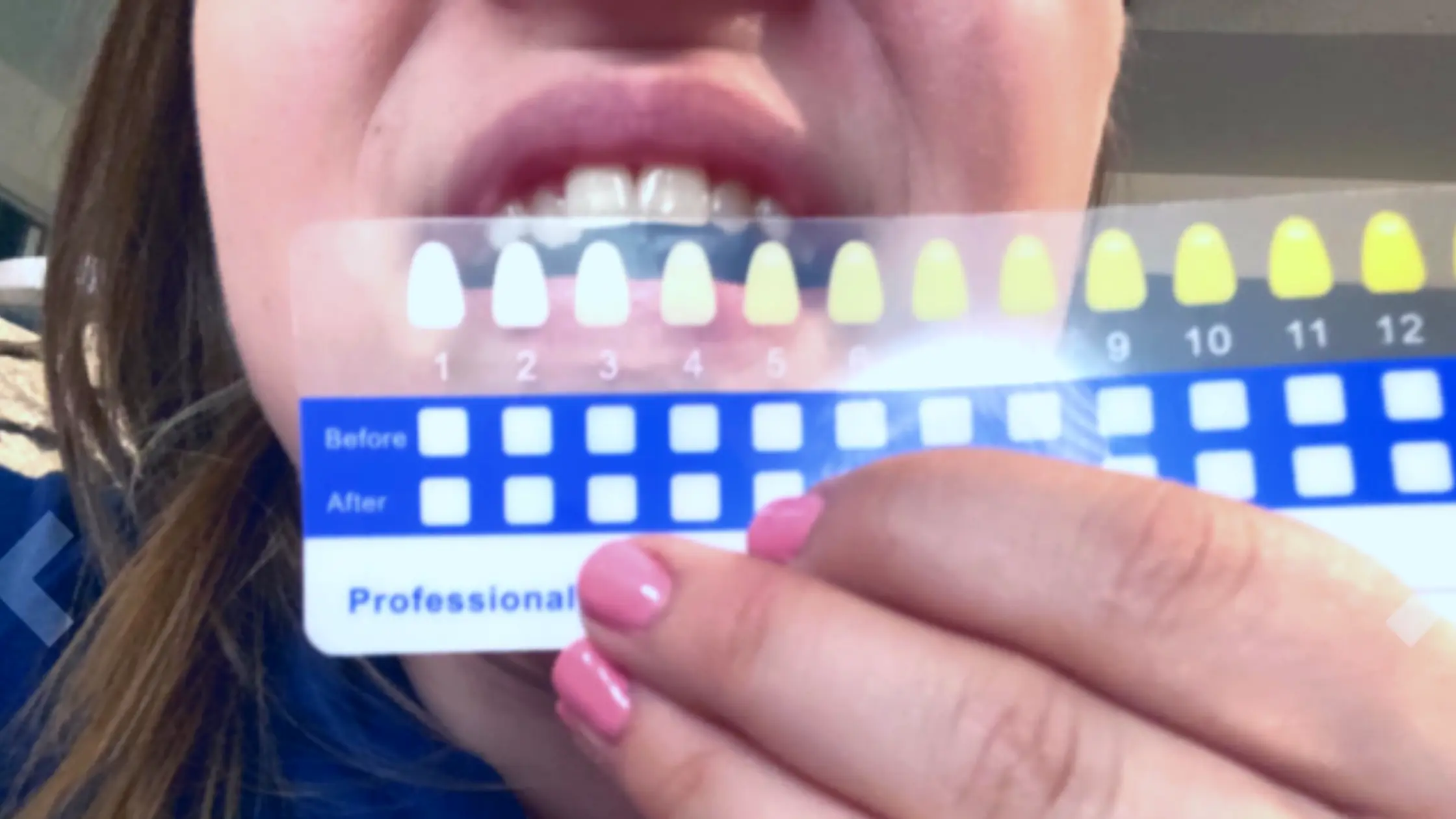 The Snow Teeth Whitening Kit Results