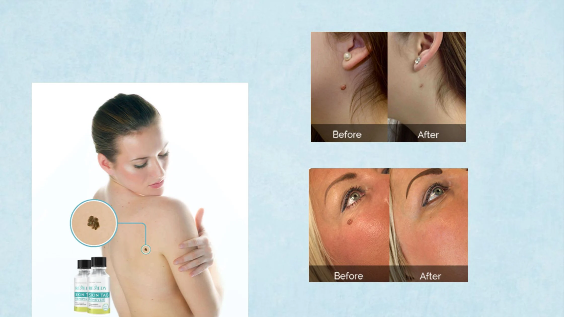 Remedy Skin Tag Remover before and after