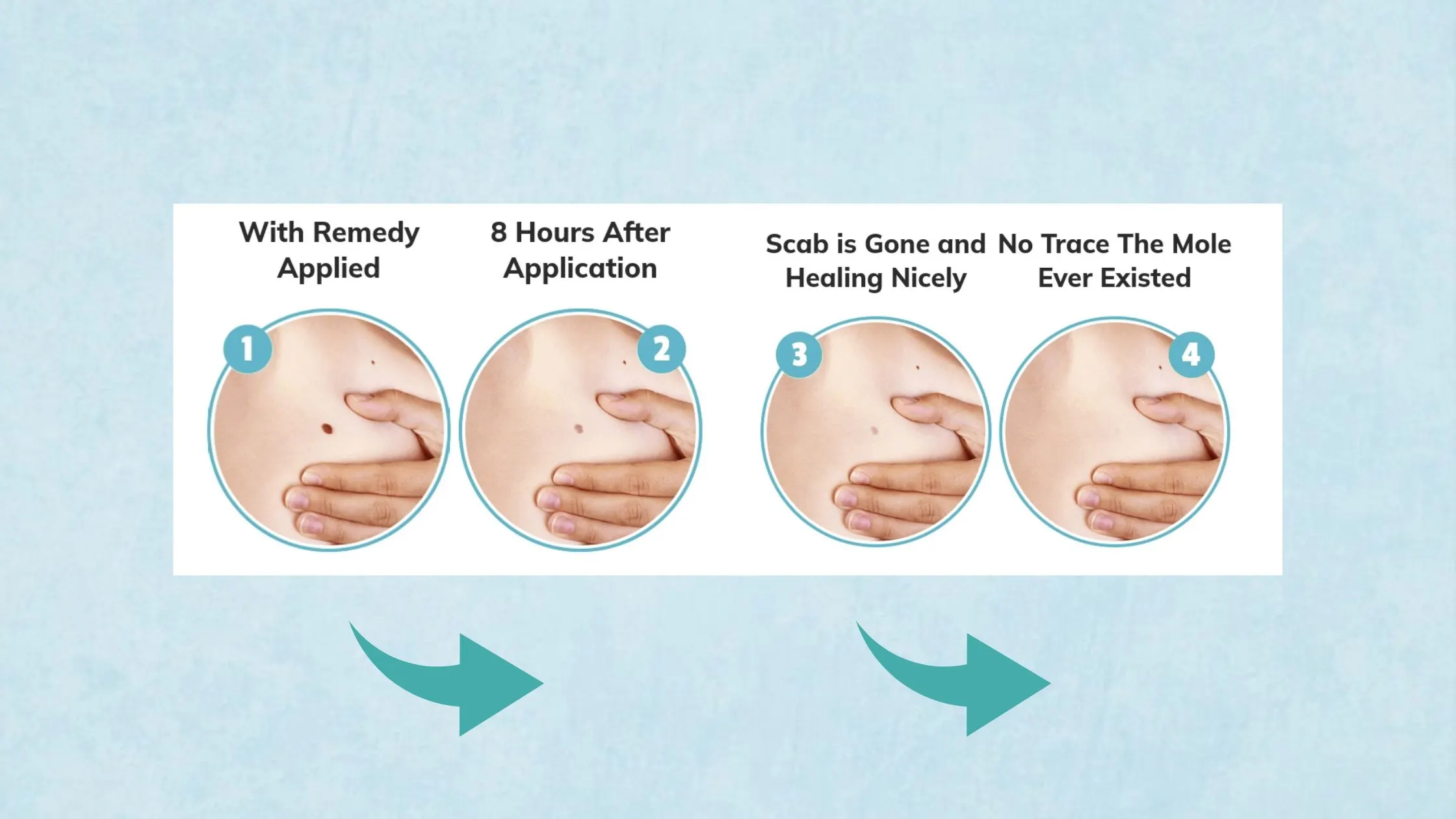 Remedy Skin Tag Remover process of working