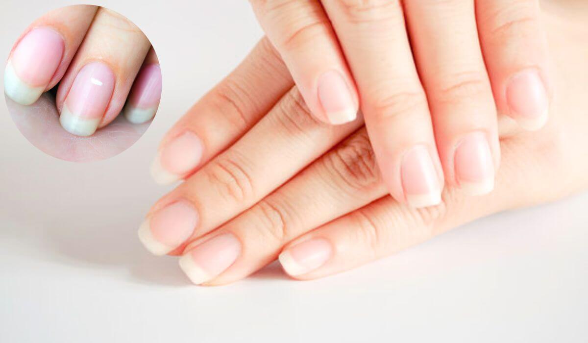 Texture Changes And Color Changes In Your Nails May Indicate Illness