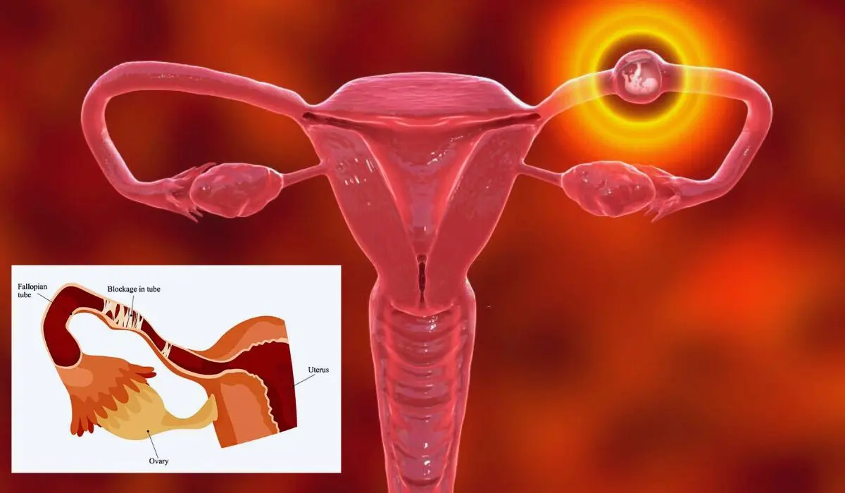 Blocked Fallopian Tubes