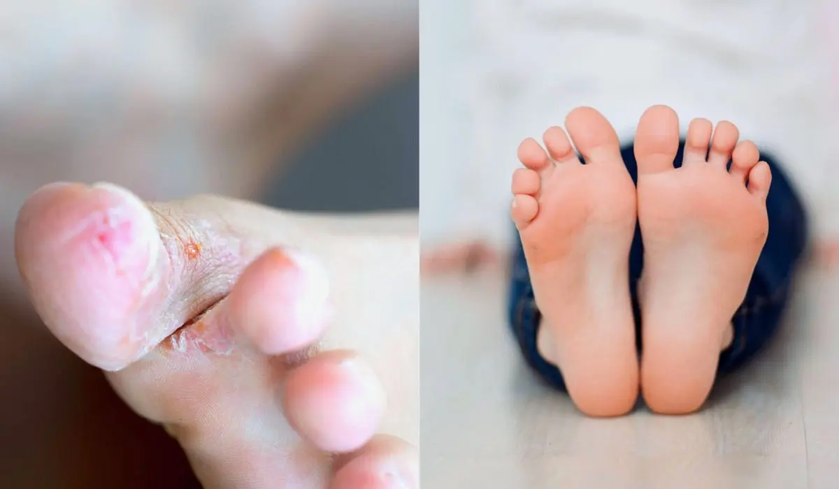 Cause Of Foot Fungus