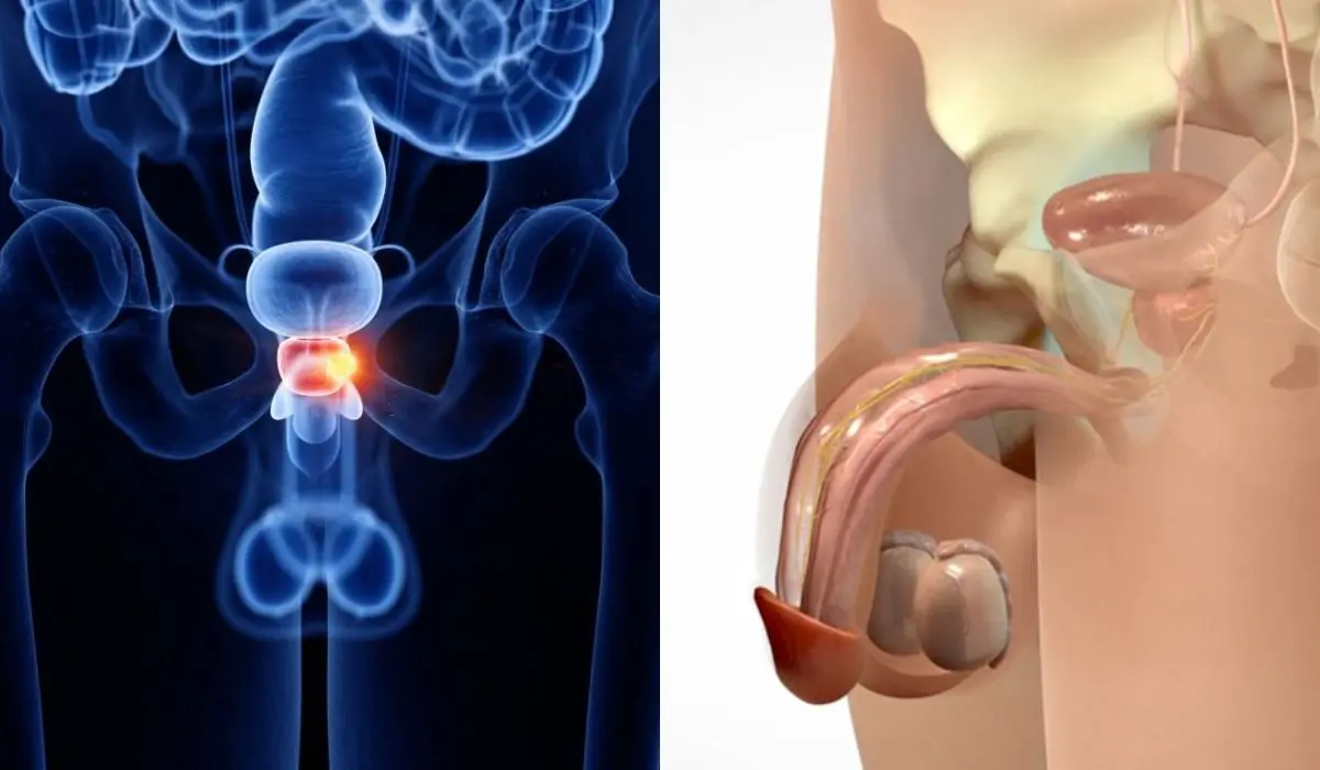 Effects Of Prostate Removal On Sexual Health 