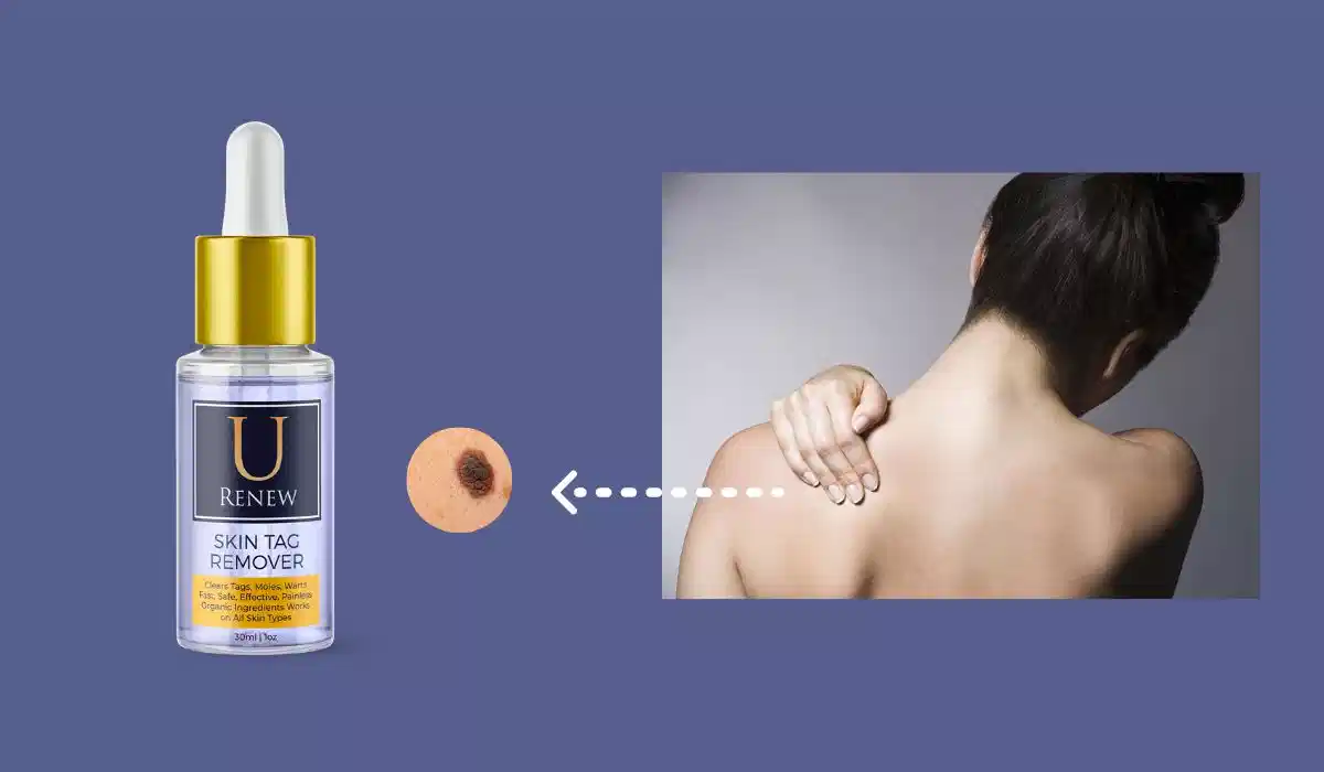 Skin Tag Remover Benefits