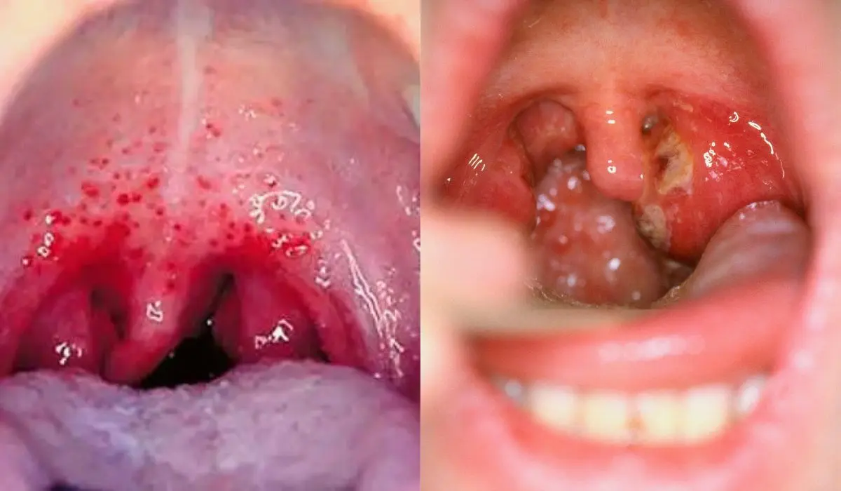 Treatment Options Available For Gonorrhea In The Throat 
