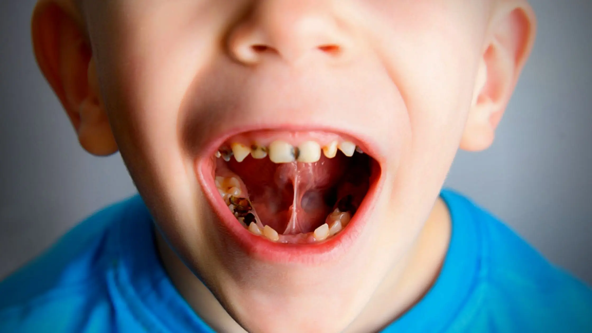 What Causes Tooth Decay Signs Of Tooth Decay