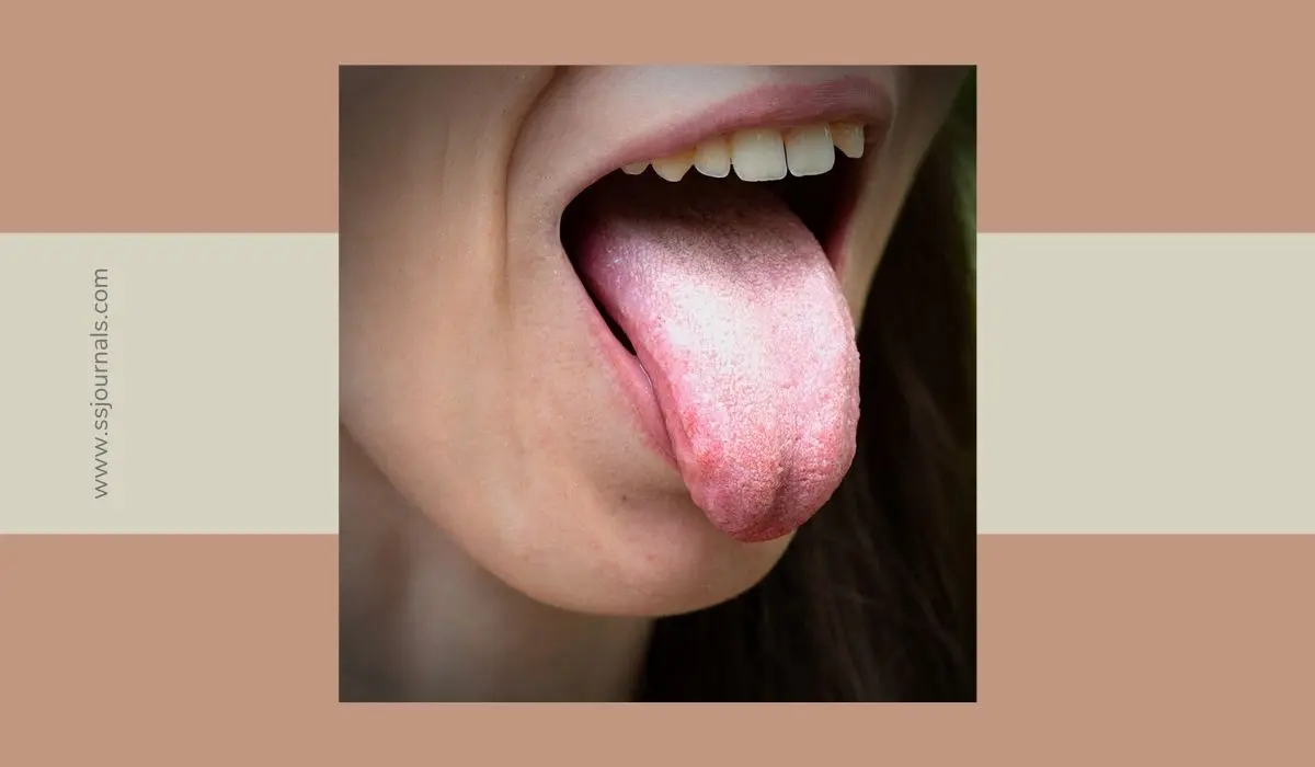 What Does It Mean When Your Tongue Is White?