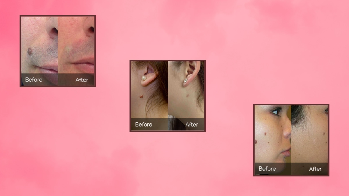 DermiSolve Skin Tag Remover before and after