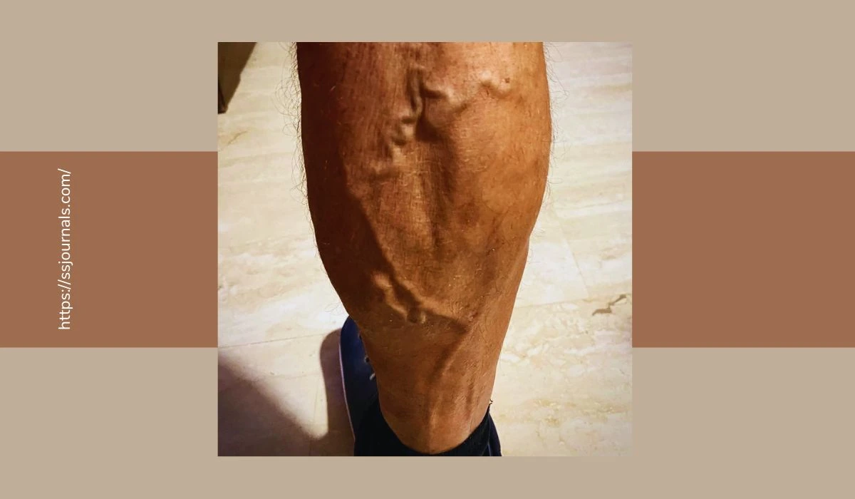 Know The Symptoms Of Varicose Veins In Men Causes, And Treatment