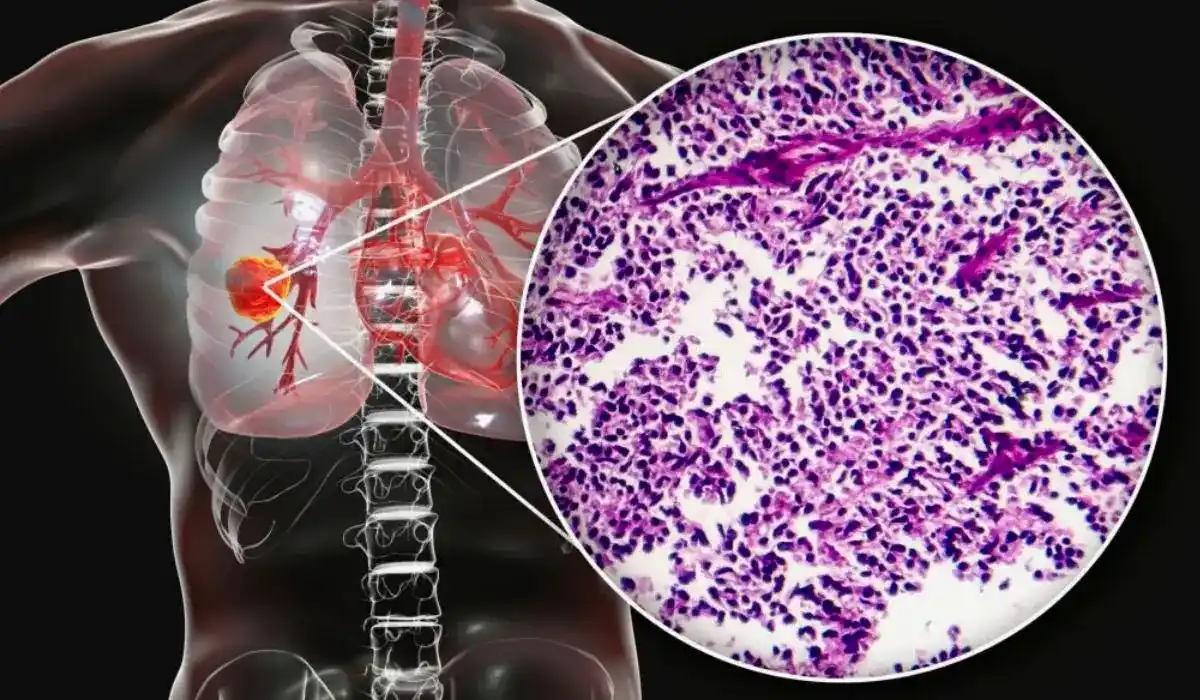 Understanding Lung Tumors