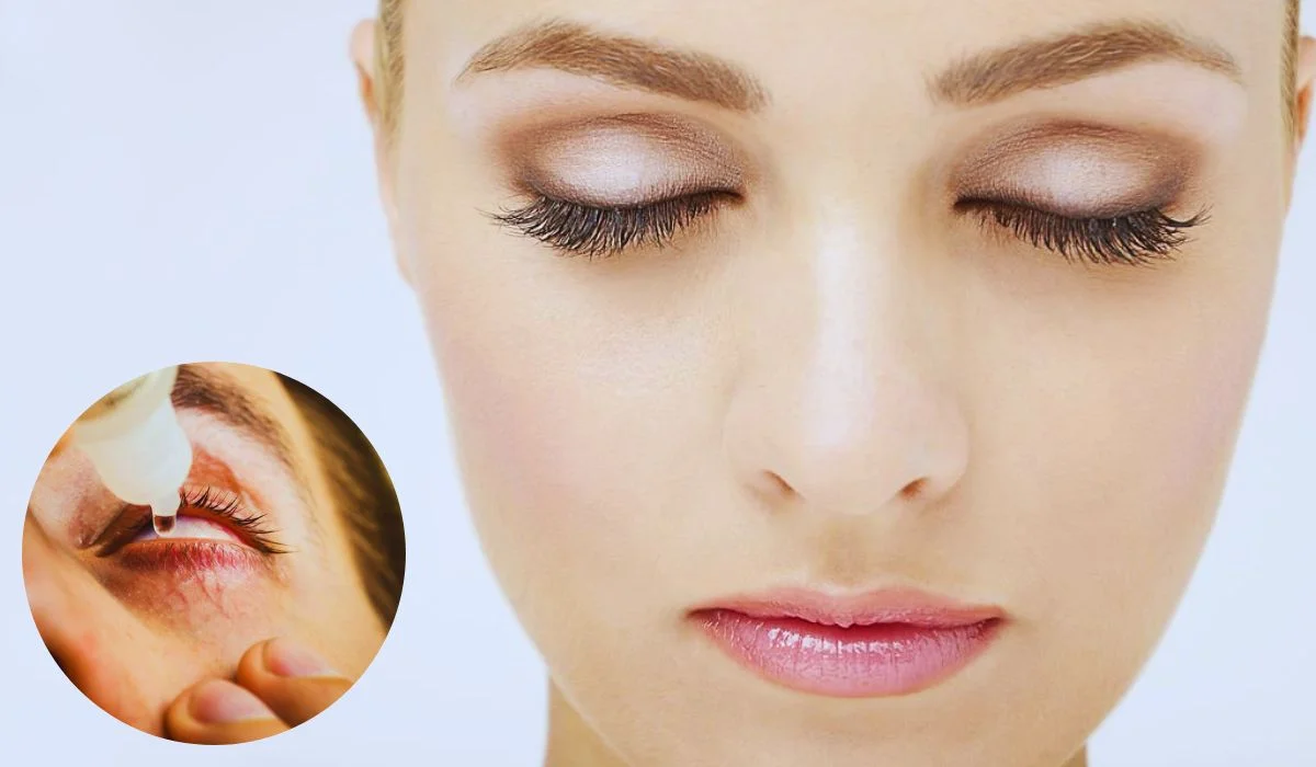 Veiny Eyelids Causes Treatment And Prevention
