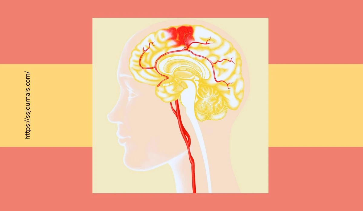 What Are The Brain Blood Clot Symptoms, Causes, And Treatments