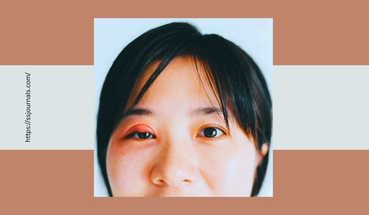 What Causes A Swollen Eyelid Prevention And Effective Treatments