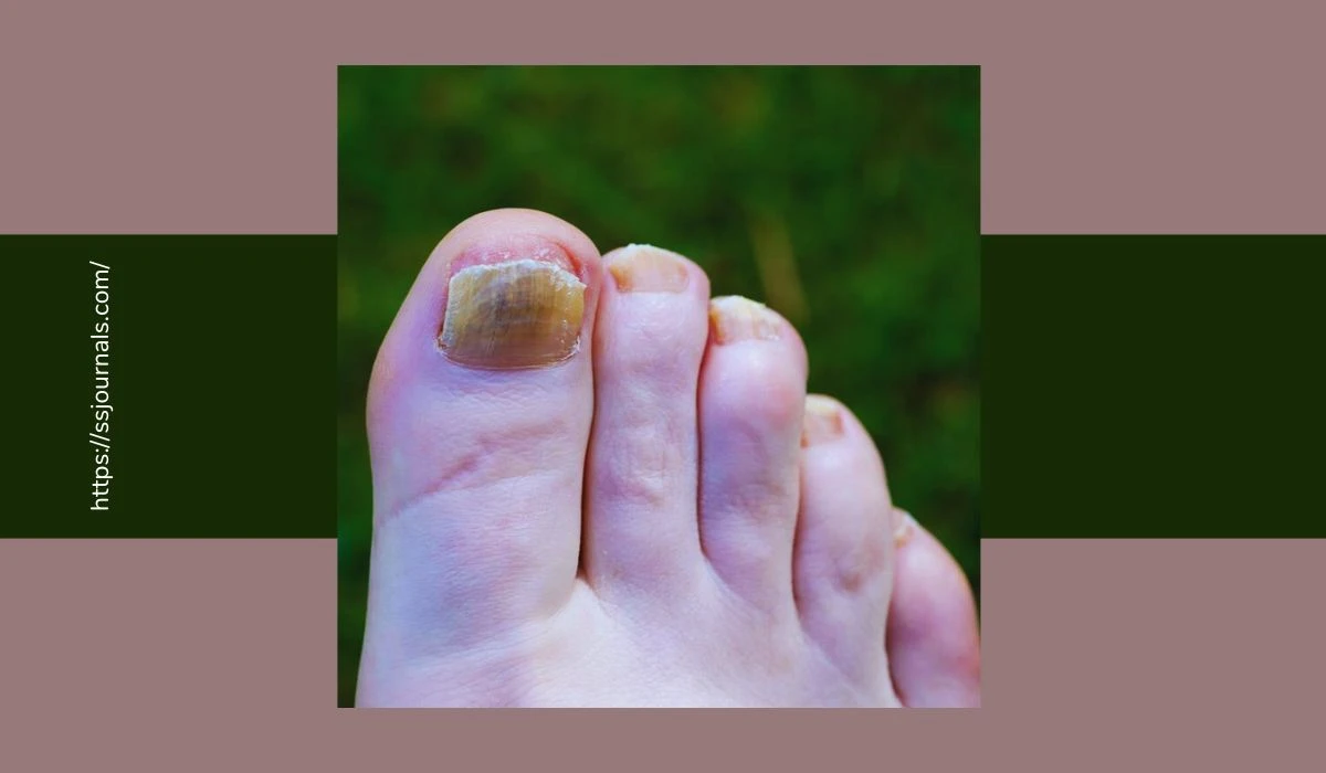 Are Toenail Fungus Contagious What You Need To Know