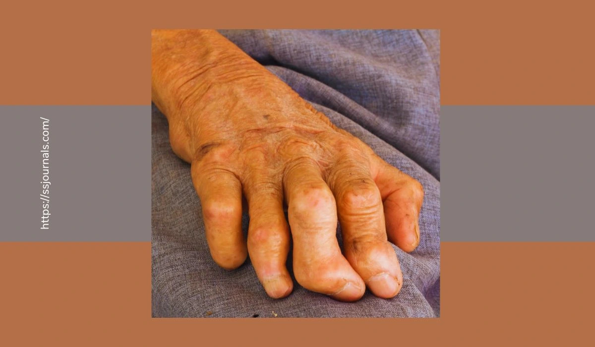 Common Symptoms Of Leprosy Major Signs For Early Detection