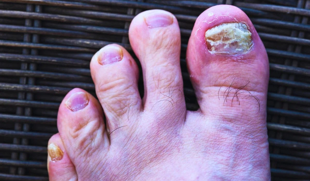 Different Types Of Toe Nail Fungus