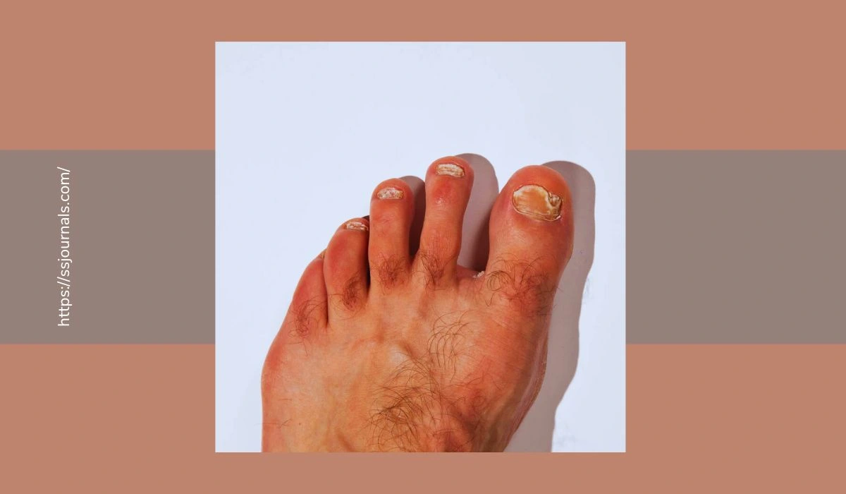 Identify Different Types Of Toe Nail Fungus And Prevent All Varieties