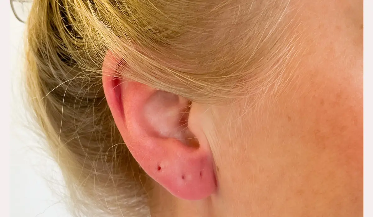 Infected Ear Piercing Common Signs And Symptoms