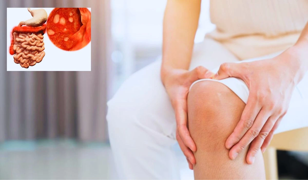Link Between Ulcerative Colitis And Joint Pain