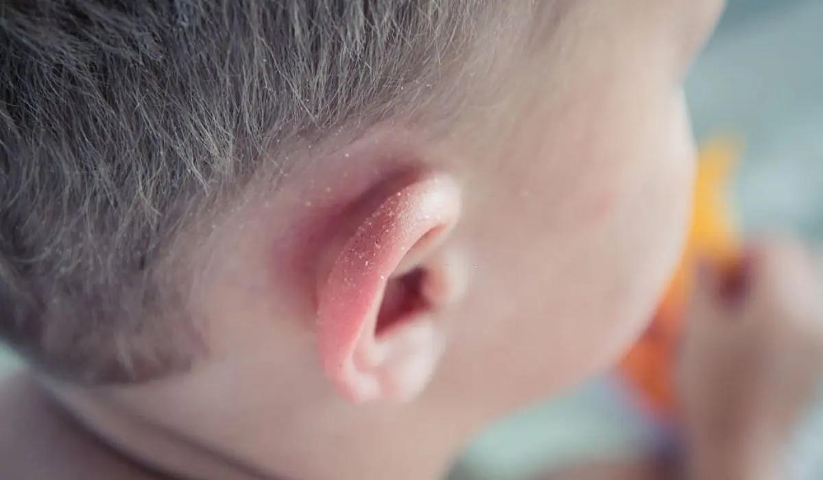 Natural Ear Eczema Treatments