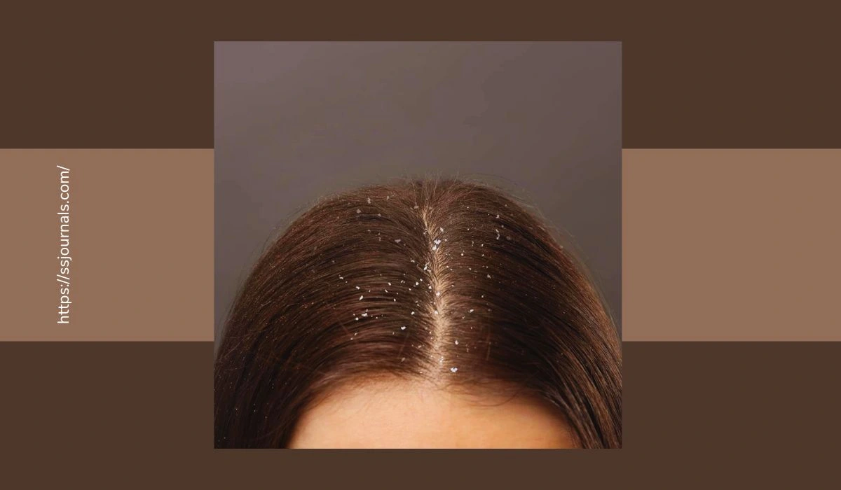 Common Dandruff Causes Revealed! Find Out The Surprising Culprits