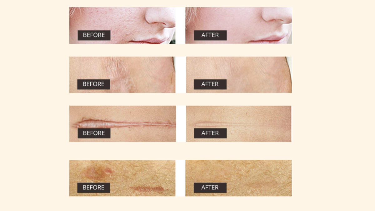 Dermefface FX7 before and after