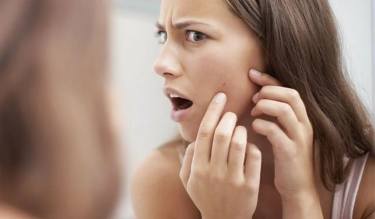 14 Effective Ways To Stop Acne