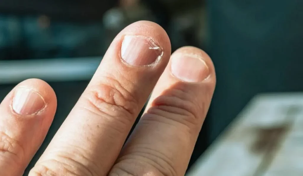Causes Of Black Lines On Nails