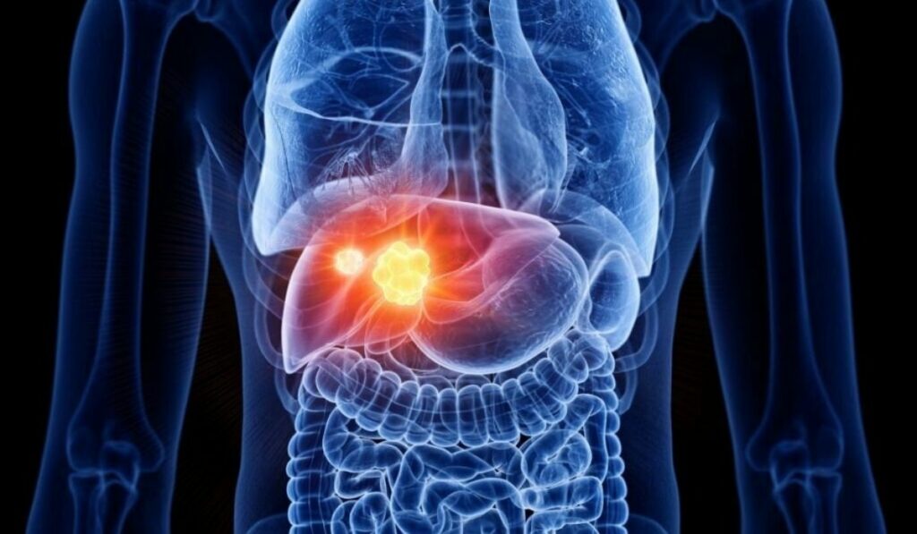 Does Lupus Affect The Liver? Liver Abnormalities in Systemic Lupus