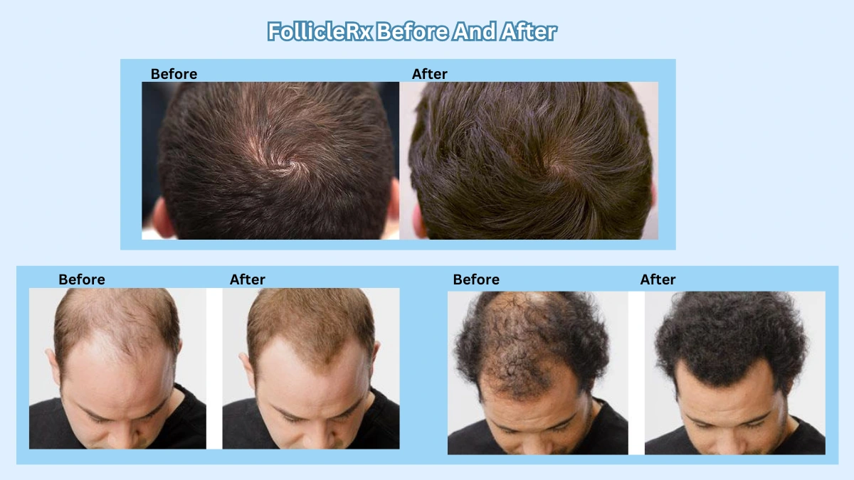 FollicleRx Before And After