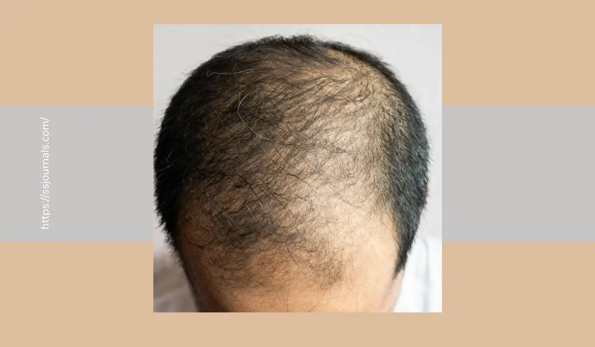How To Grow Hair In Bald Spot