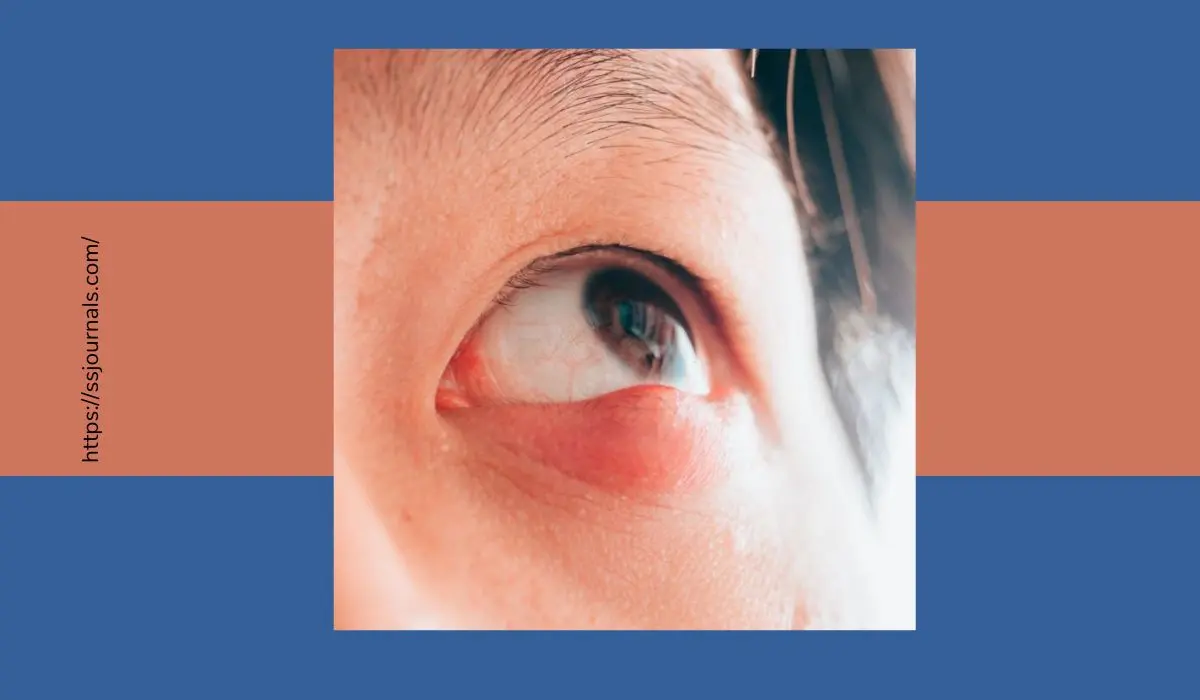 Is A Stye Contagious