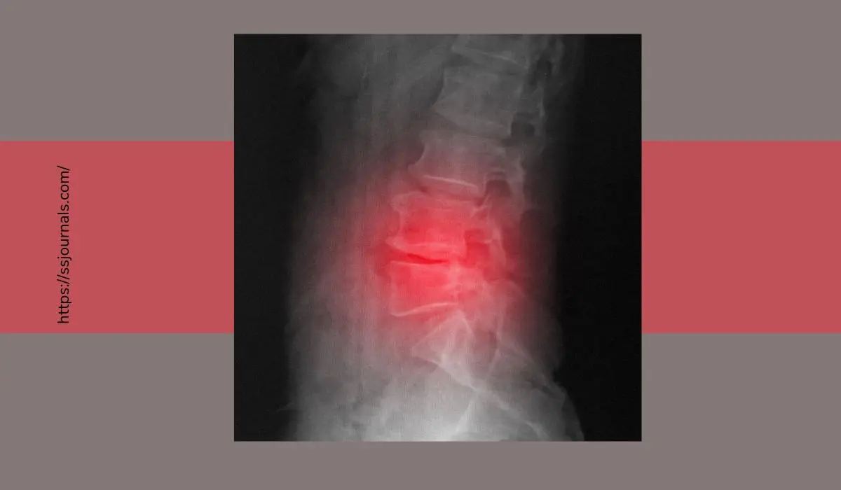 Thoracic Spondylosis