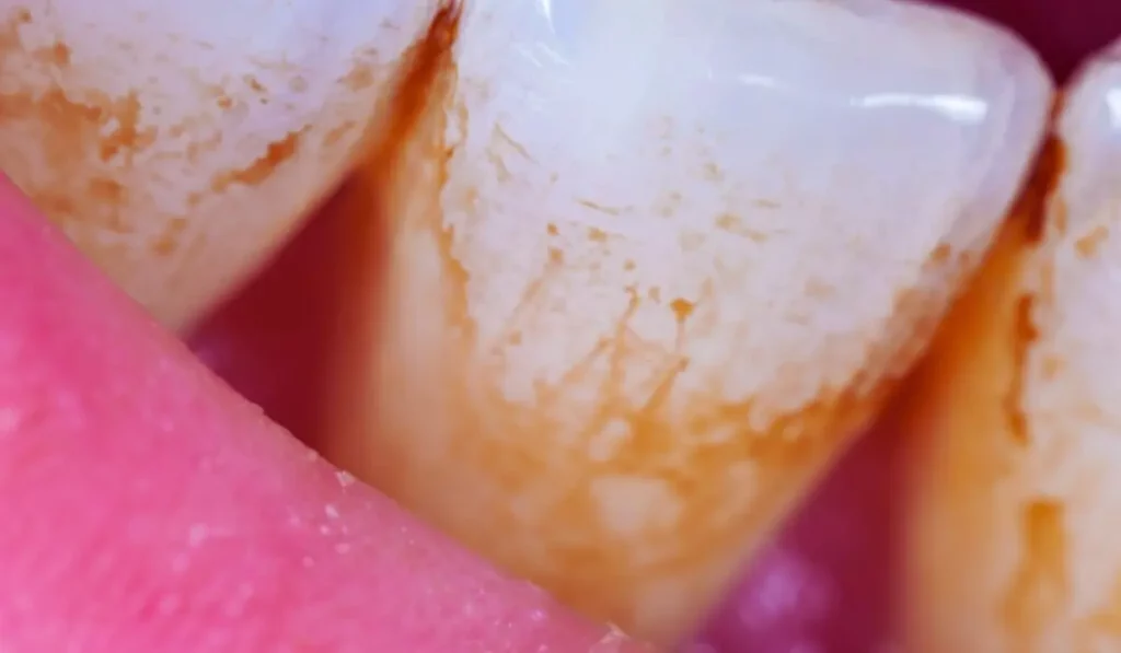 Understanding Mellow Gum Recession