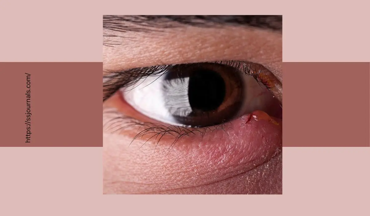 What Causes Goopy Eyes And How to Treat Them