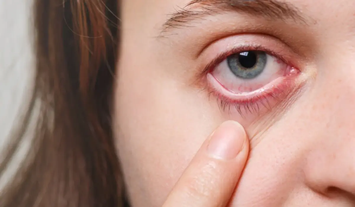What Is Dry Eye Syndrome