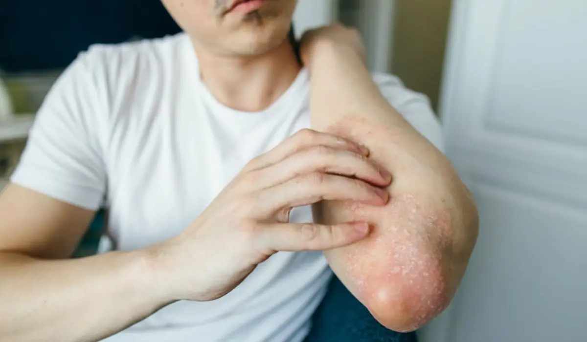 What Is Eczema