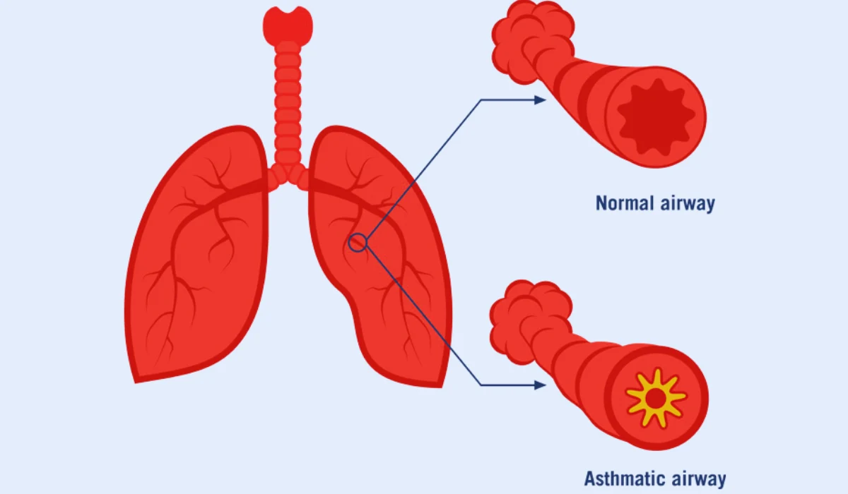 Asthma