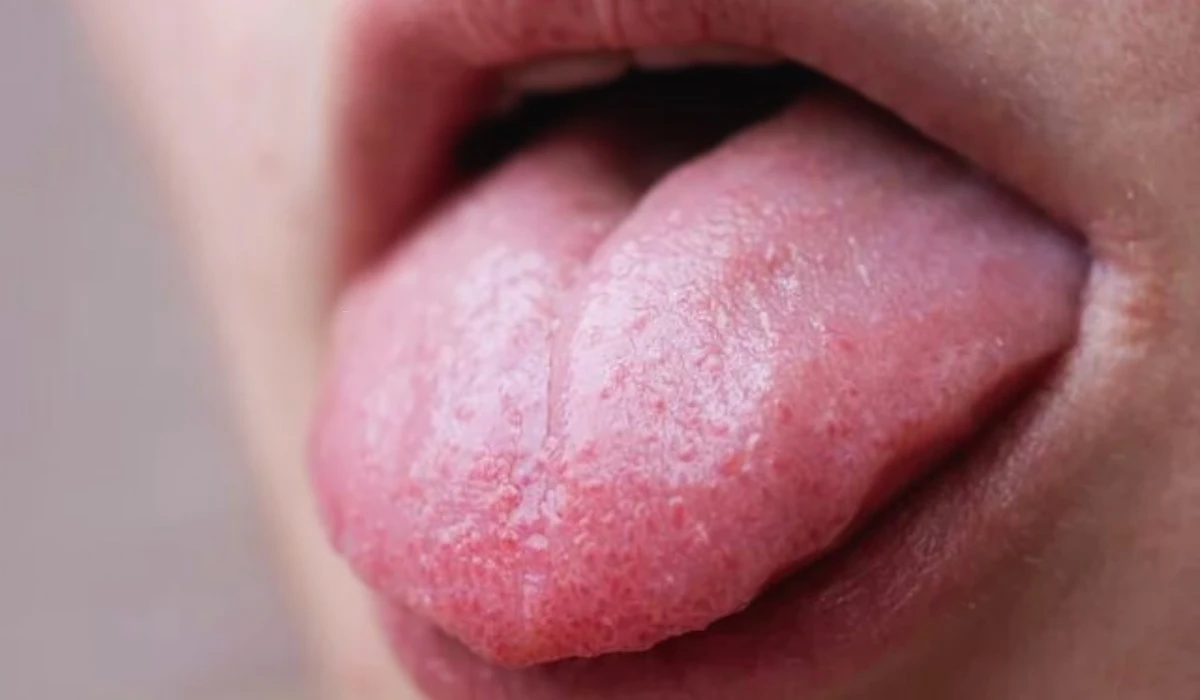 Bumps On The Tongue
