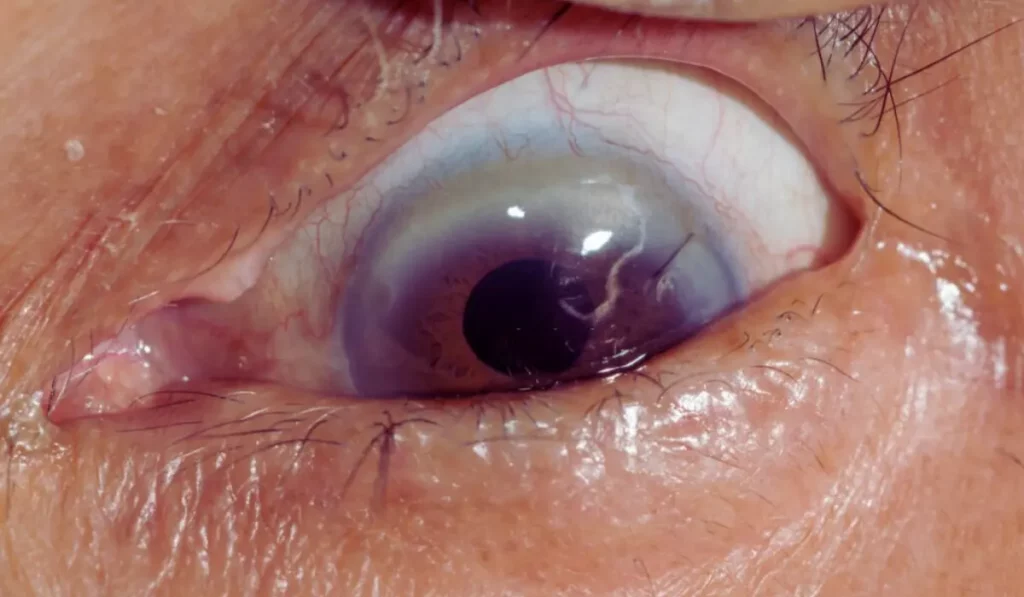 Causes Of Ocular Tuberculosis