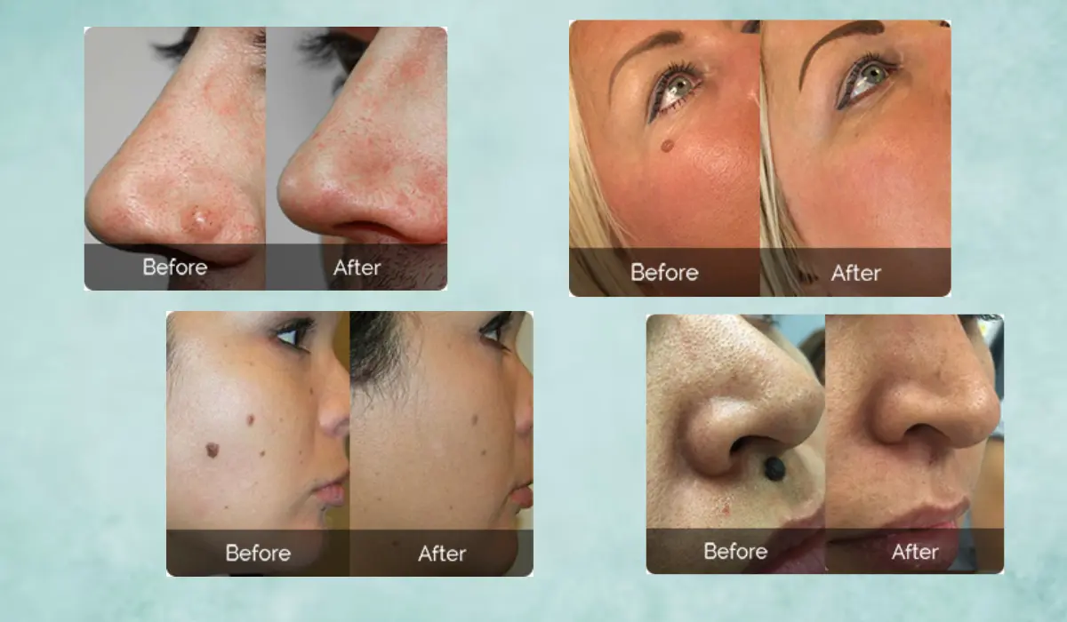 Clean as Teen Skin Tag Remover Before And After
