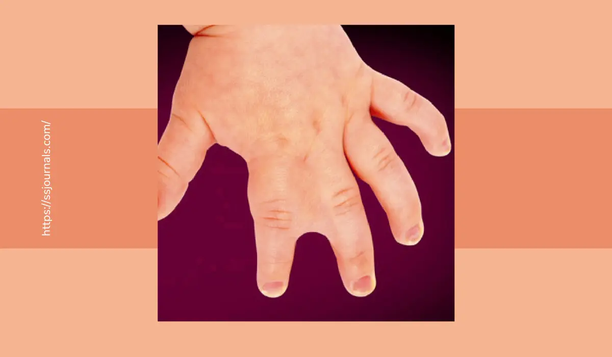 Congenital Hand Deformities Types and Treatments