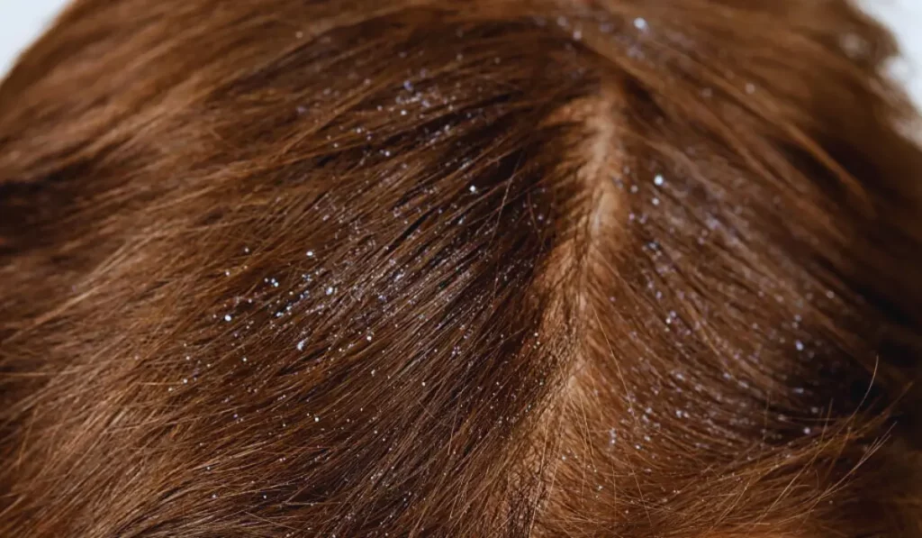 Contagious Dandruff