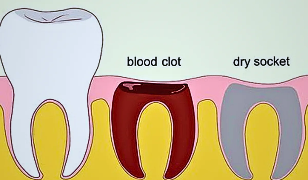 Dry Socket After Tooth Extraction