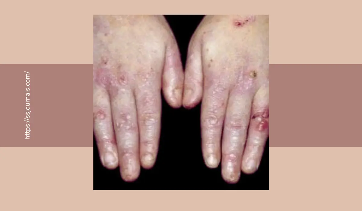 Epidermolysis Bullosa Acquisita