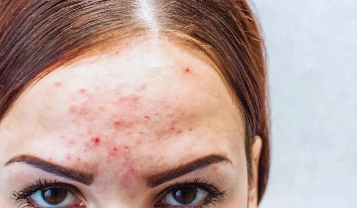  Forehead Pimples