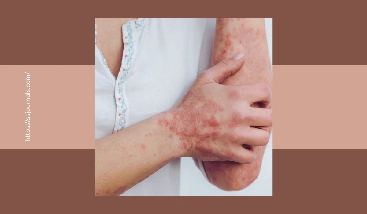 Fungal Infection on Skin