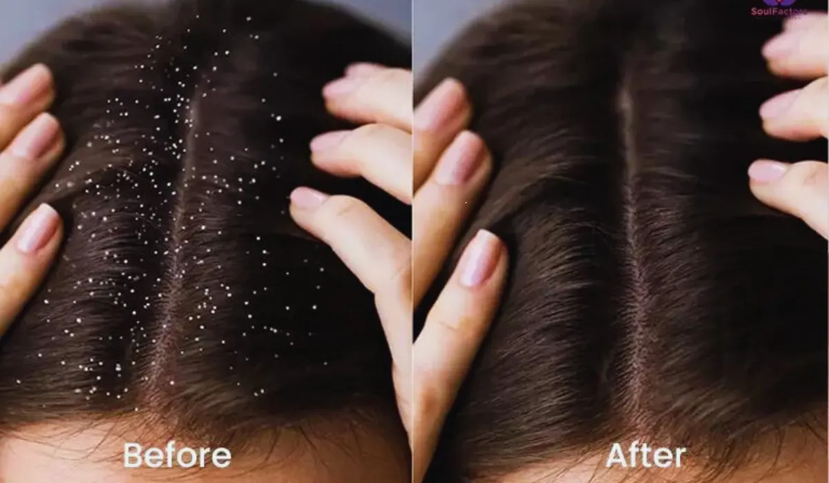 Glycolic Acid On The Scalp