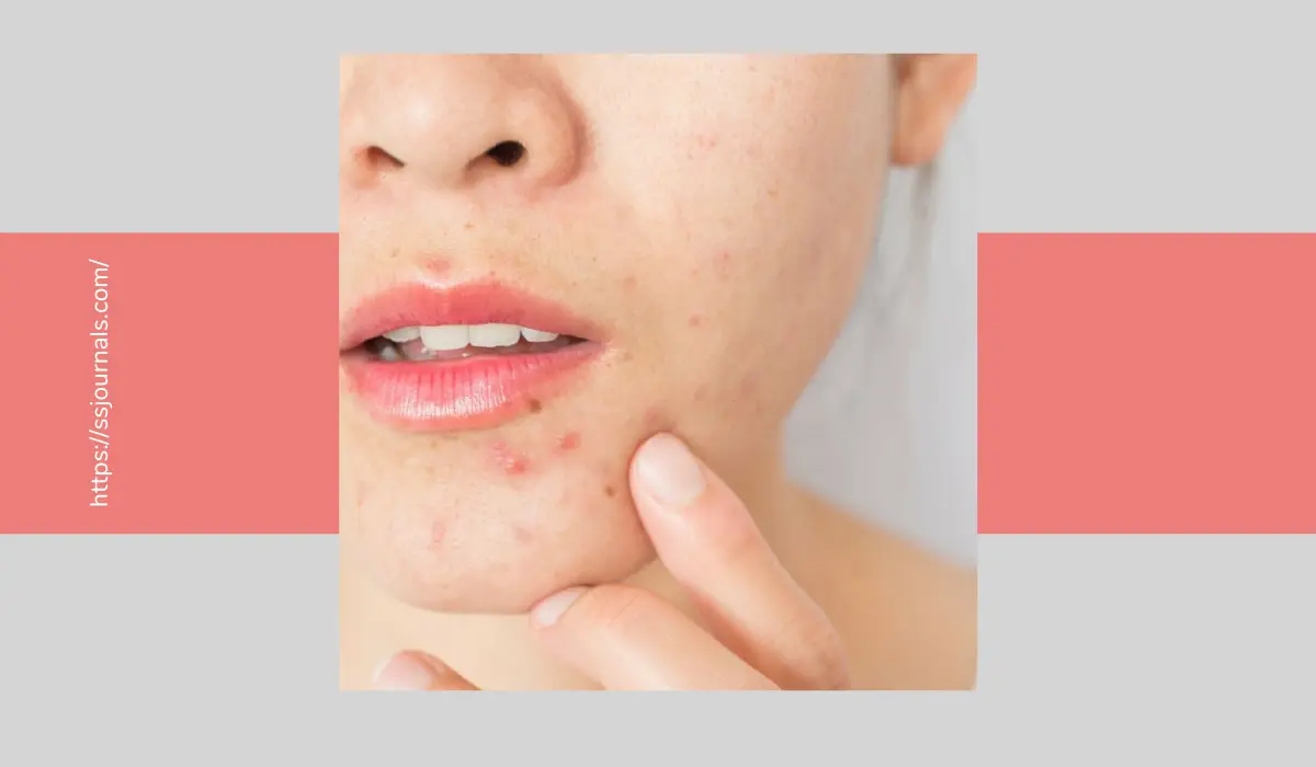 How To Get Rid Of Rosacea Permanently